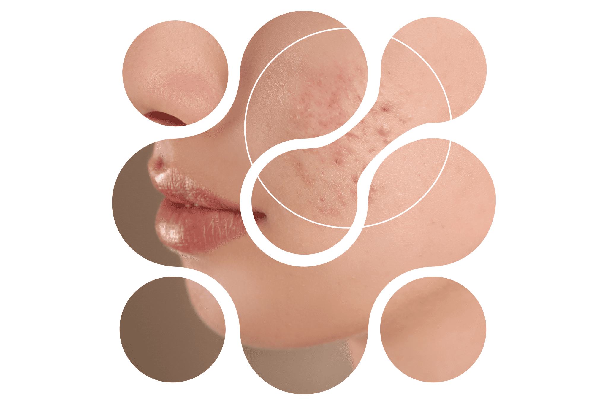 Joue avec de l'acné