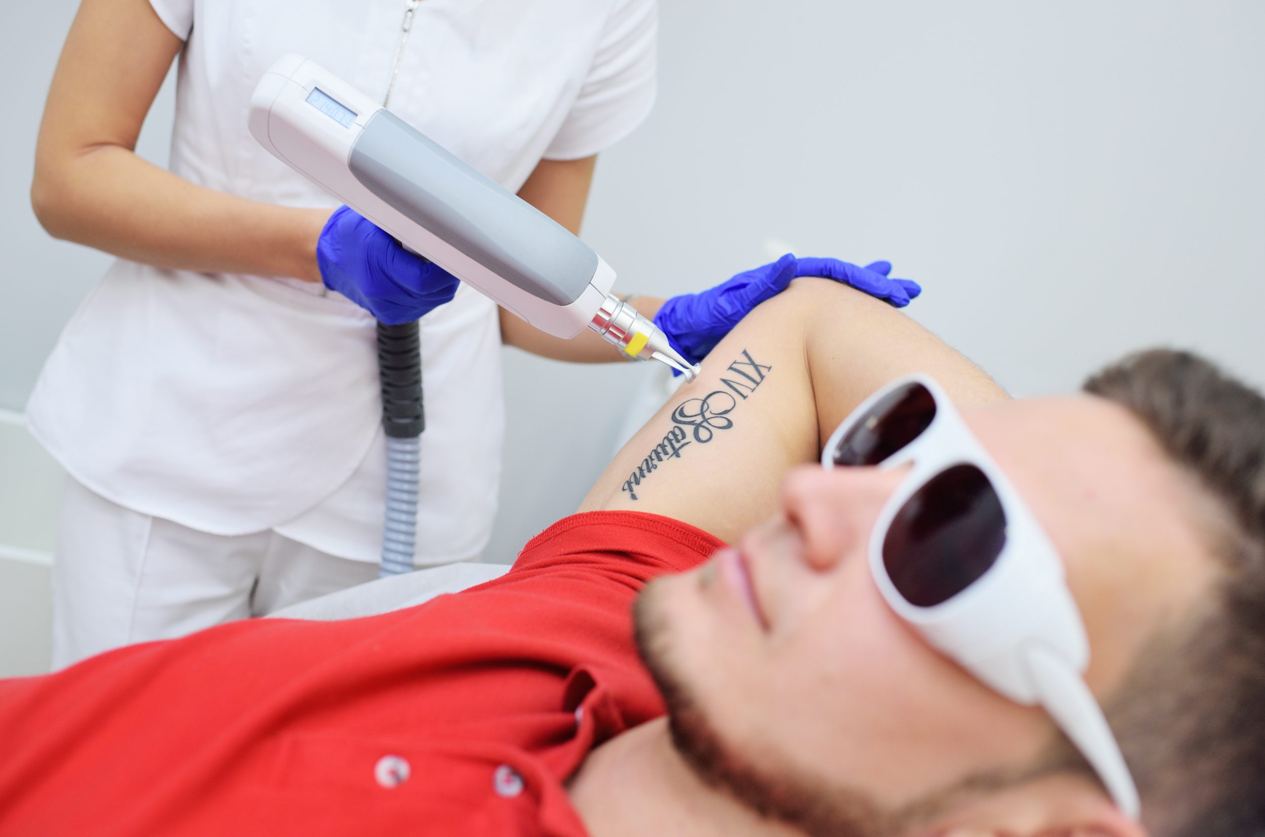 laser nd yag sur tatouage homme