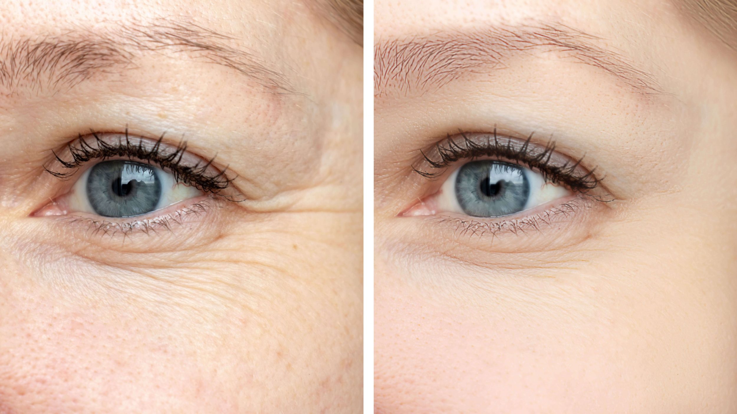 injections rides yeux