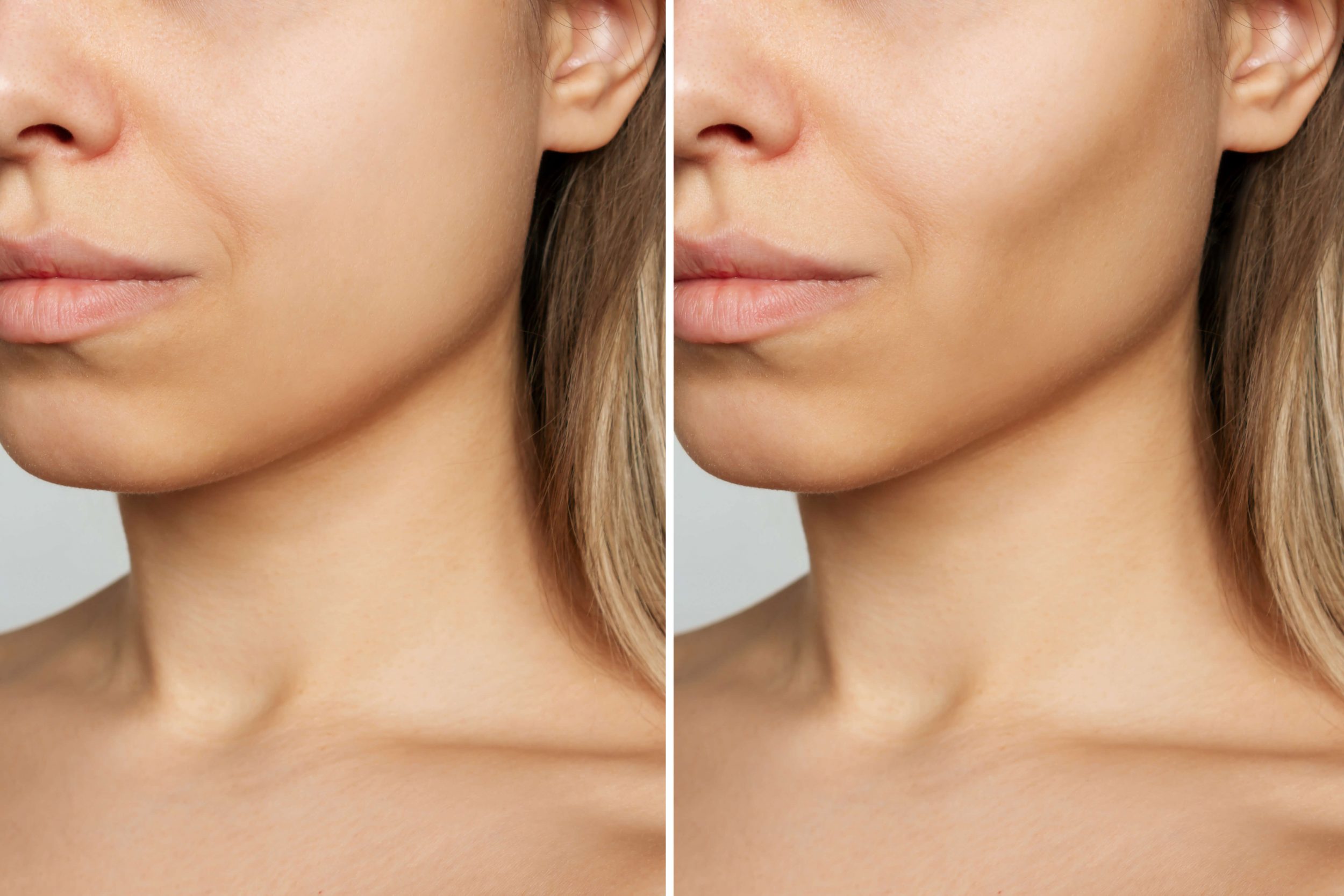 avant apres injections acide hyaluronique joues