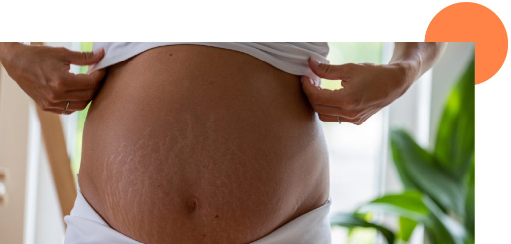 vergetures grossesse