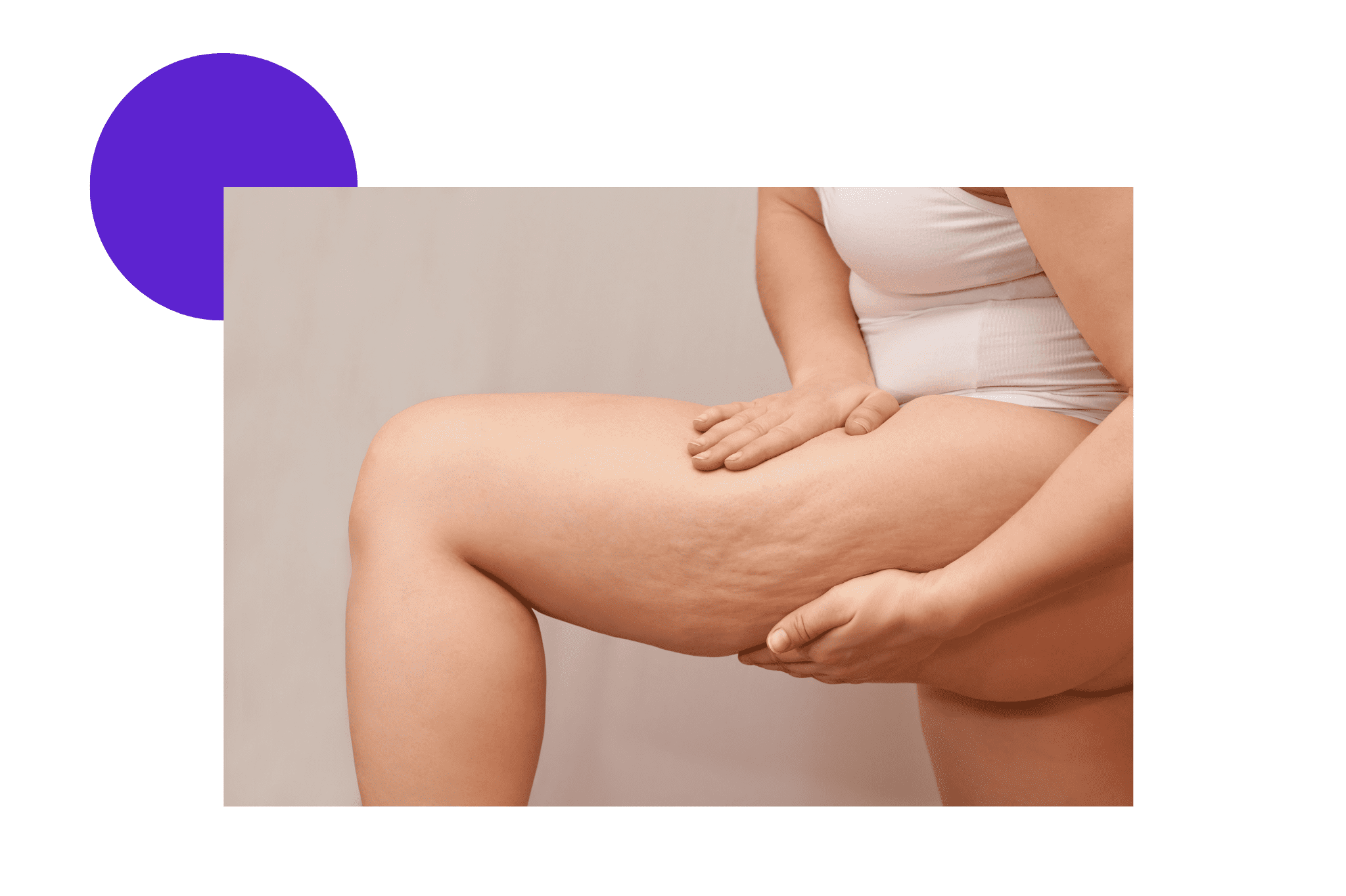 Cellulite fibreuse sur les cuisses d'une femme