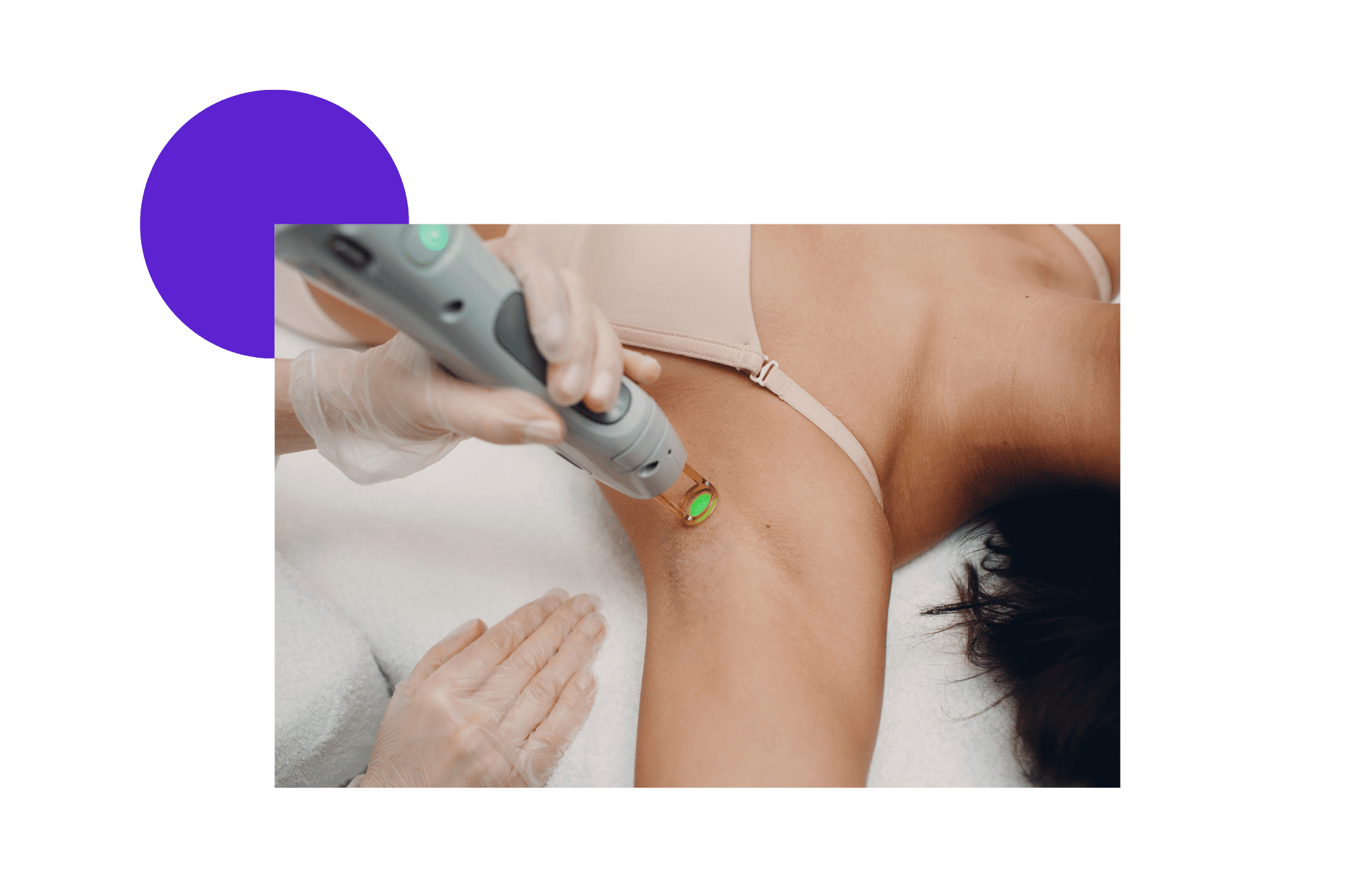 Épilation définitive au laser des aisselles