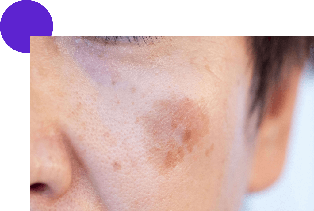 tache pigmentaire sur la joue, zoom