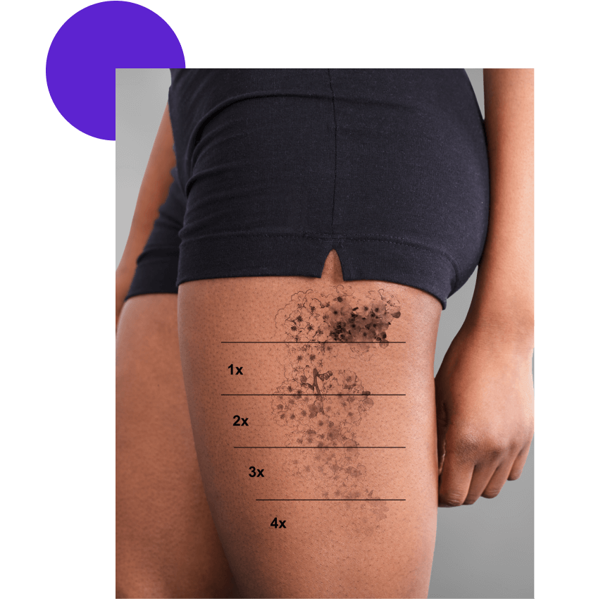 avant apres detatouage cuisse femme