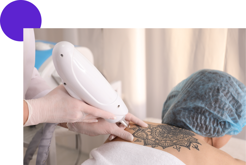 enlever tatouage avec lumiere pulsée