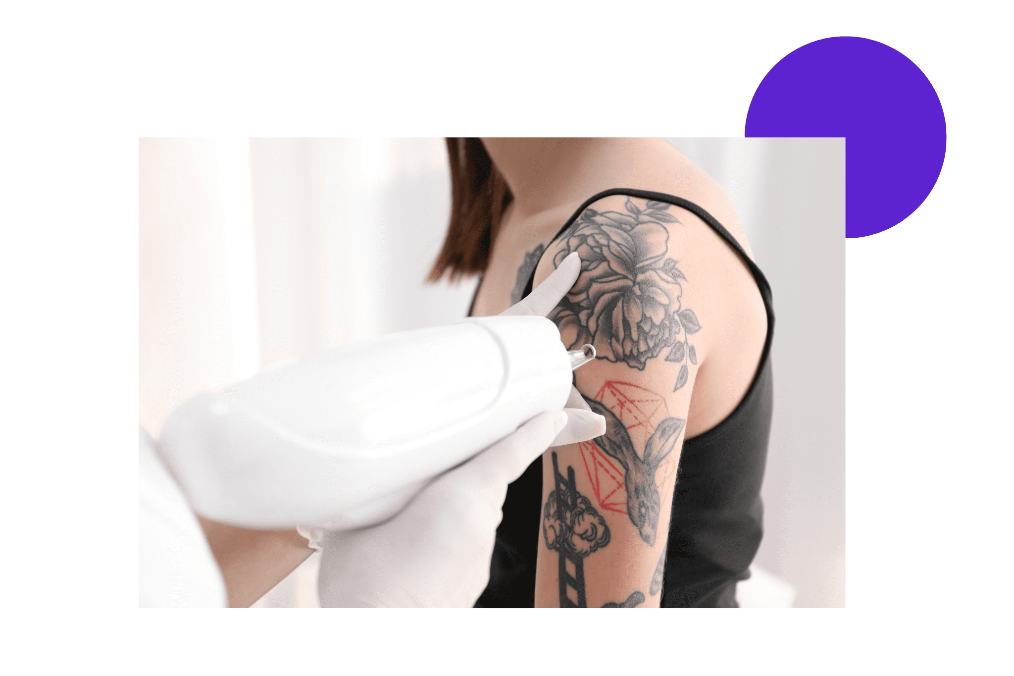 Séance de détatouage sur l'épaule d'une femme