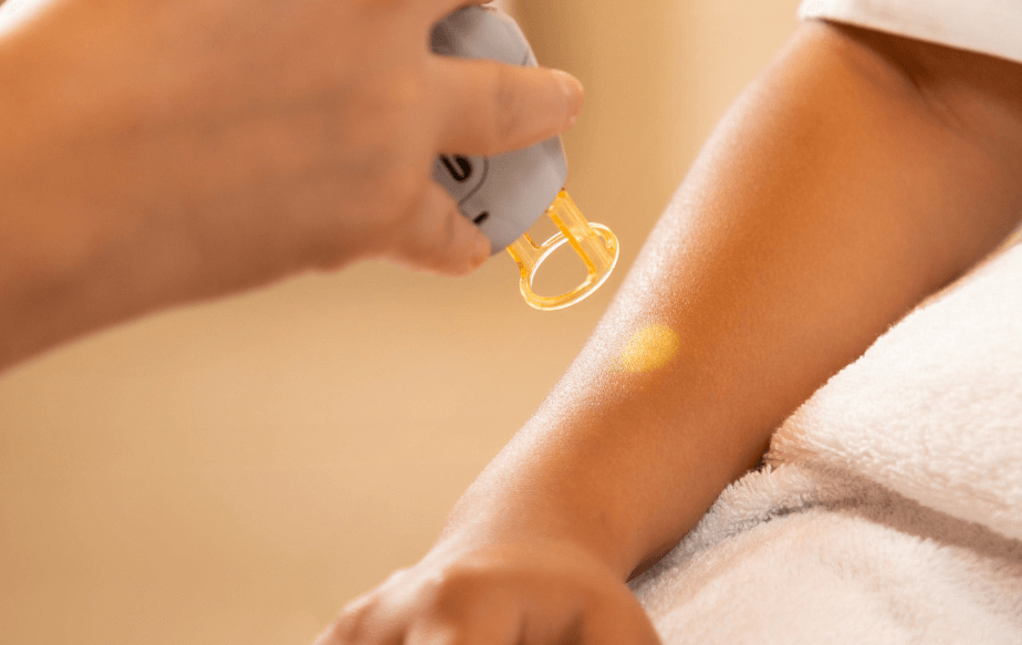 Séance d'épilation laser sur un bras