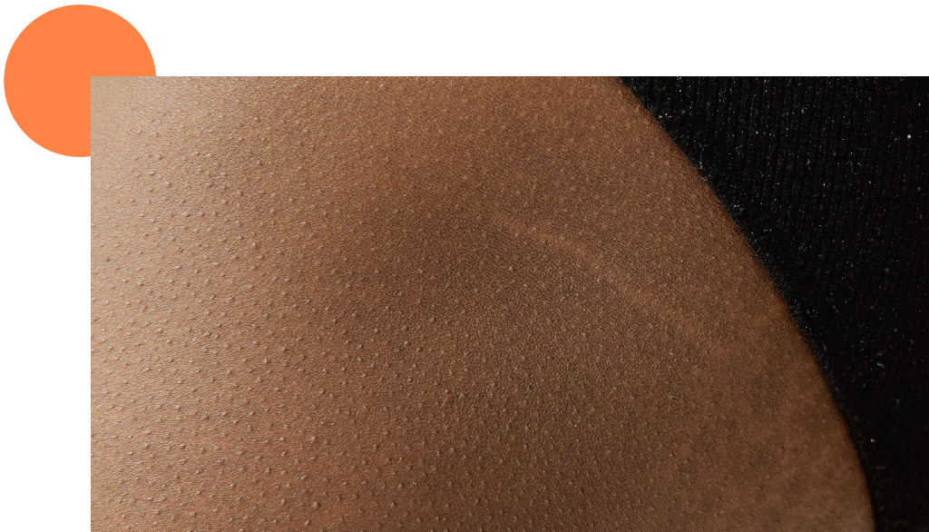 zoom sur une vergeture blanche