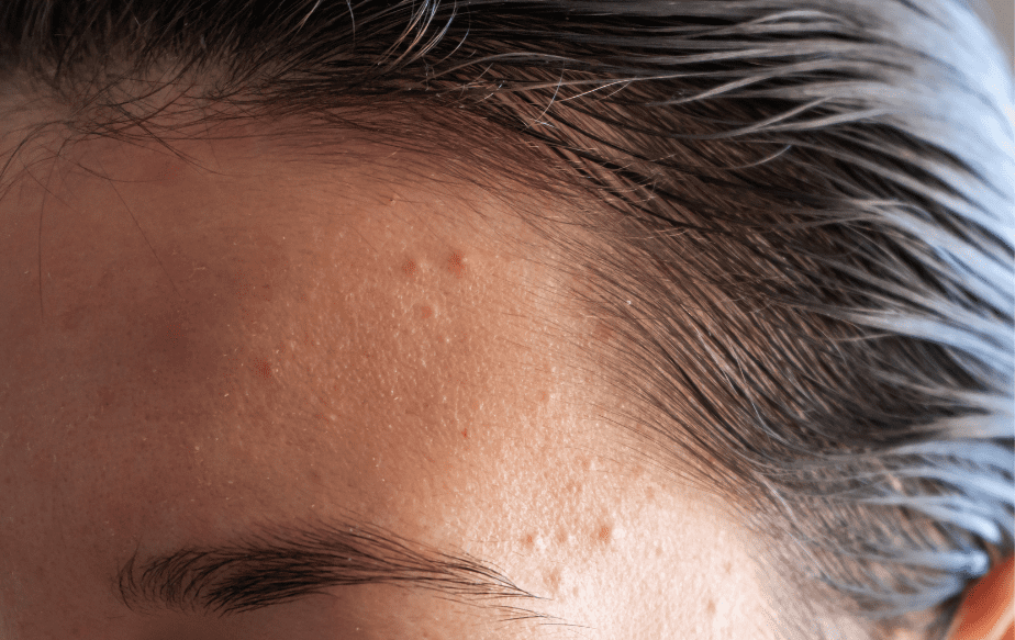 Une personne avec de l'acné hormonale sur le front