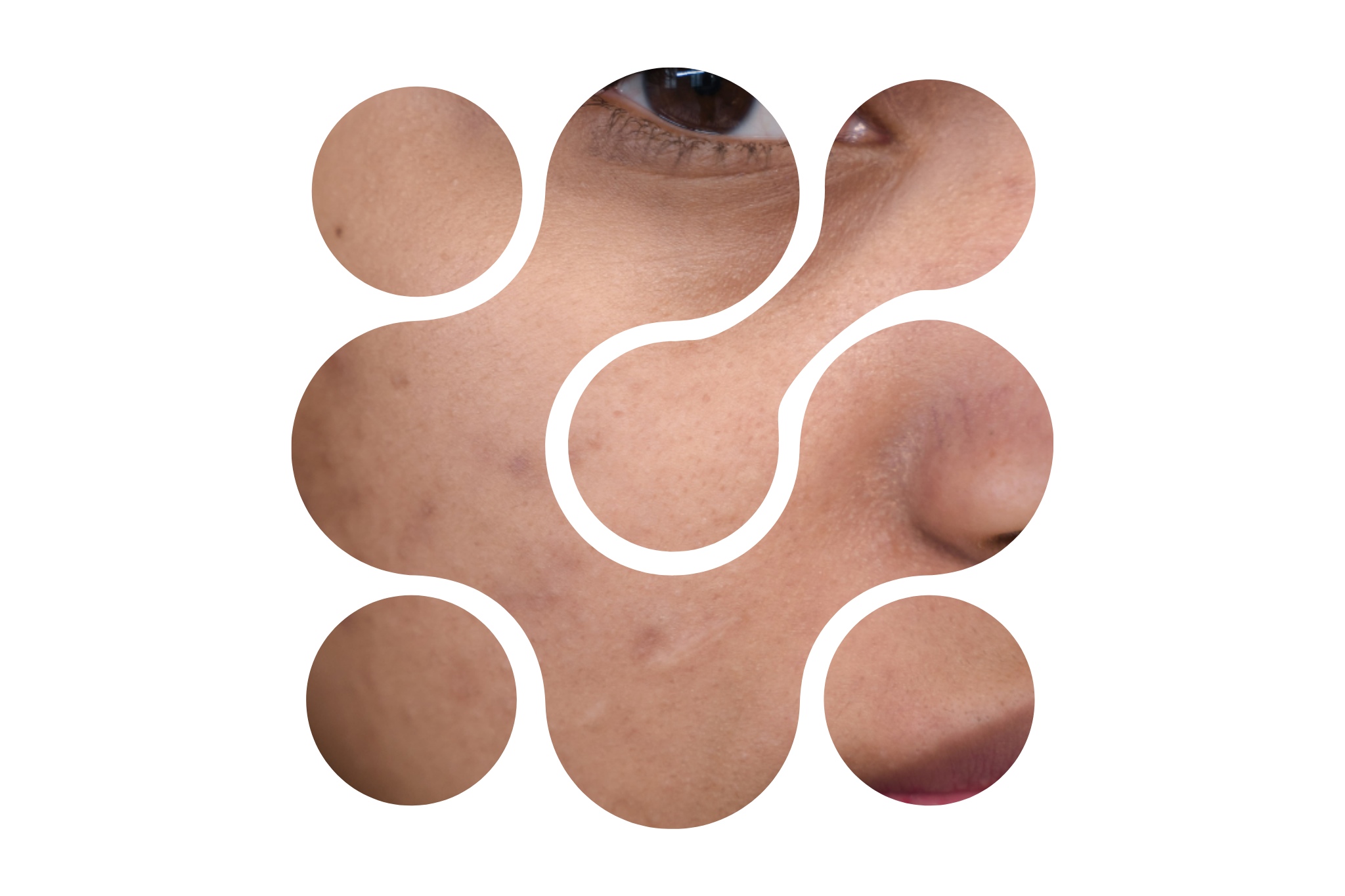 acné sur une femme asiatique