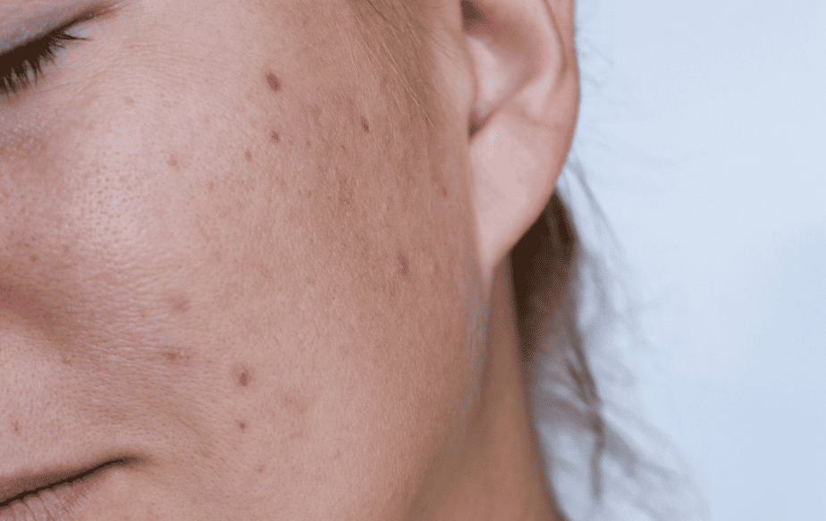 Une personne qui cherche des solutions sur Tiktok pour remédier à son acné