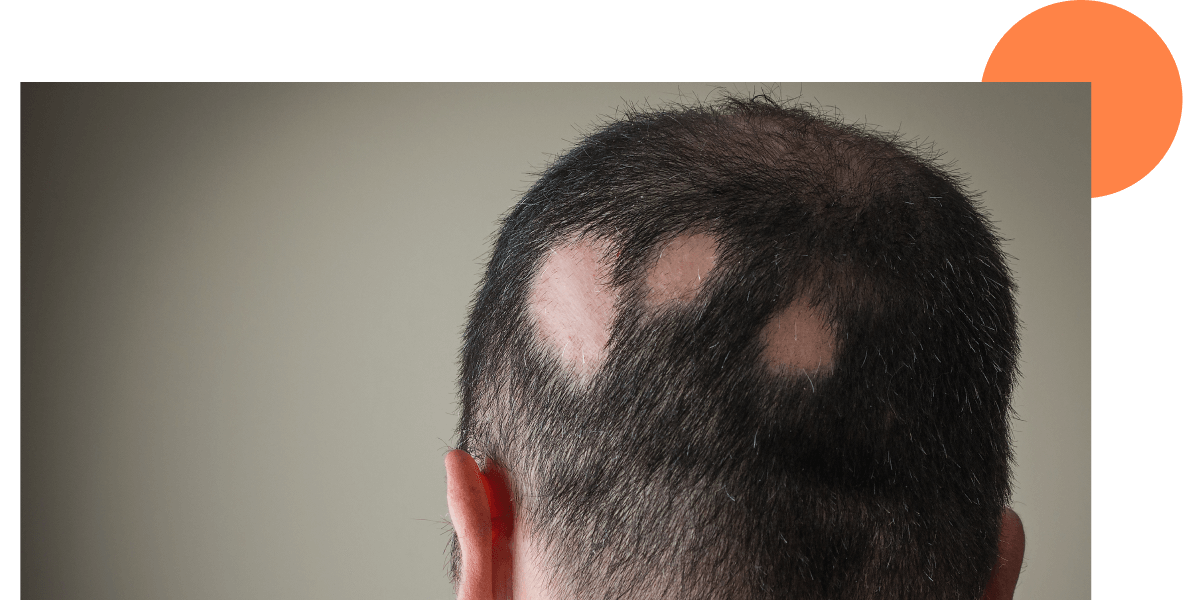 alopécie cicatricielle aperçu