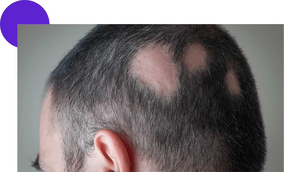 alopécie cicatricielle crane homme