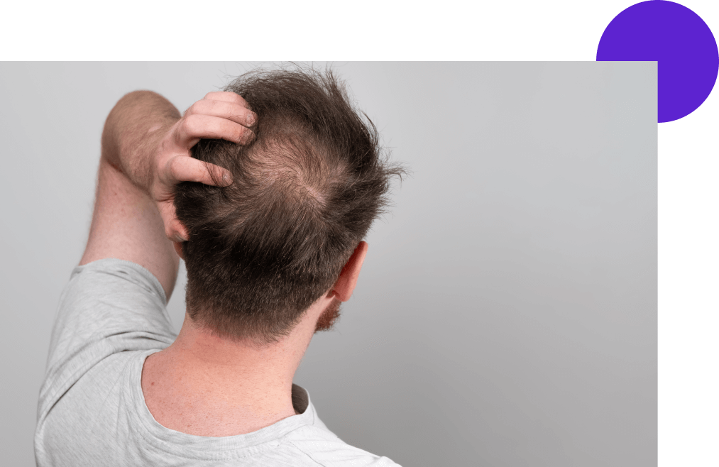 cuir chevelu d'un homme vue dessus avec de l'alopécie