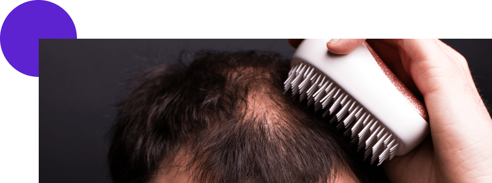 homme alopécie qui se brosse le cuir chevelu