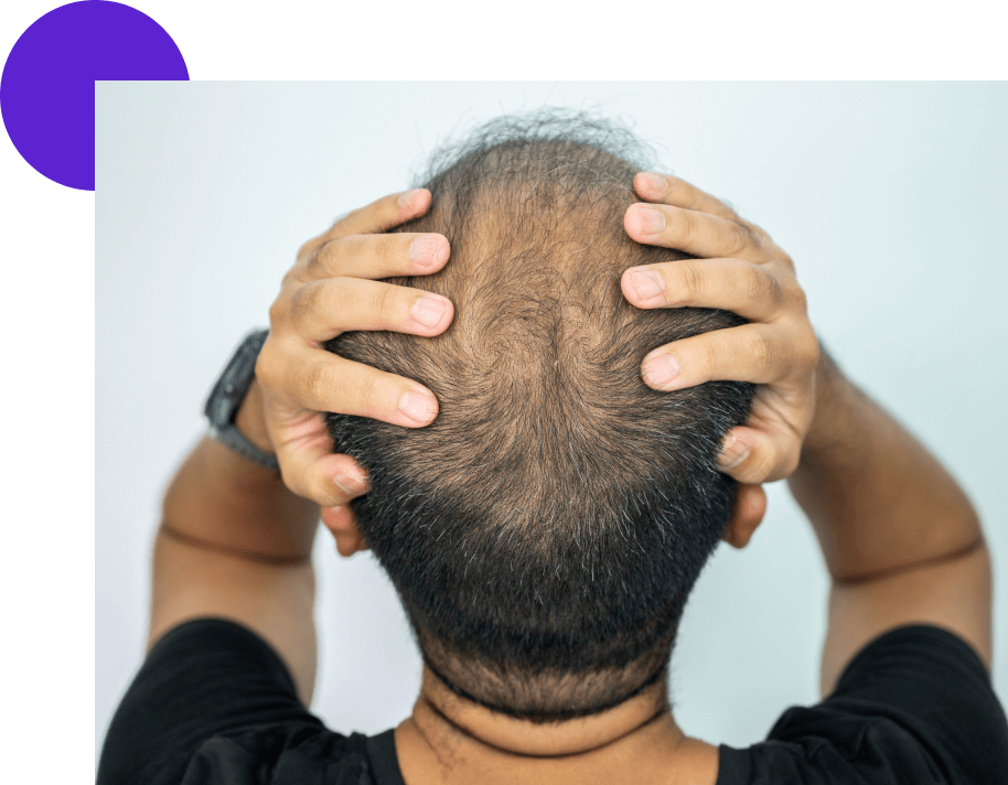 calvitie chez un homme