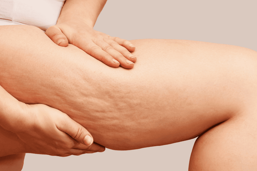 Une femme qui pince sa peau pour montrer la cellulite sur ses fesses et ses jambes