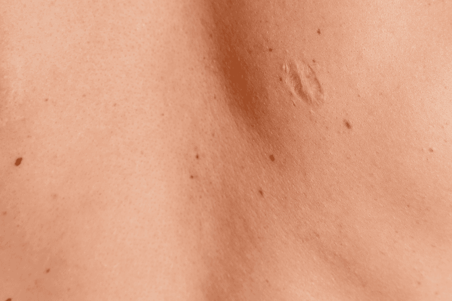 Photo de plusieurs cicatrices d'une personne sur son dos vues de très près