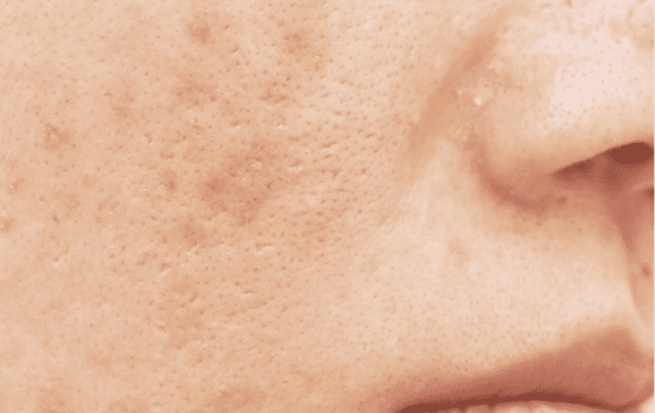 joues avec taches brunes causées par l'acné