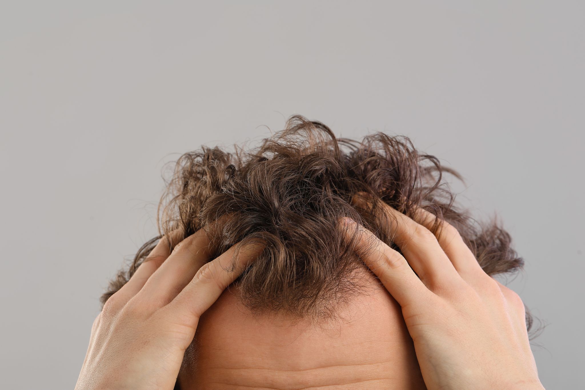 Un homme atteint de calvitie qui veut faire une greffe capillaire