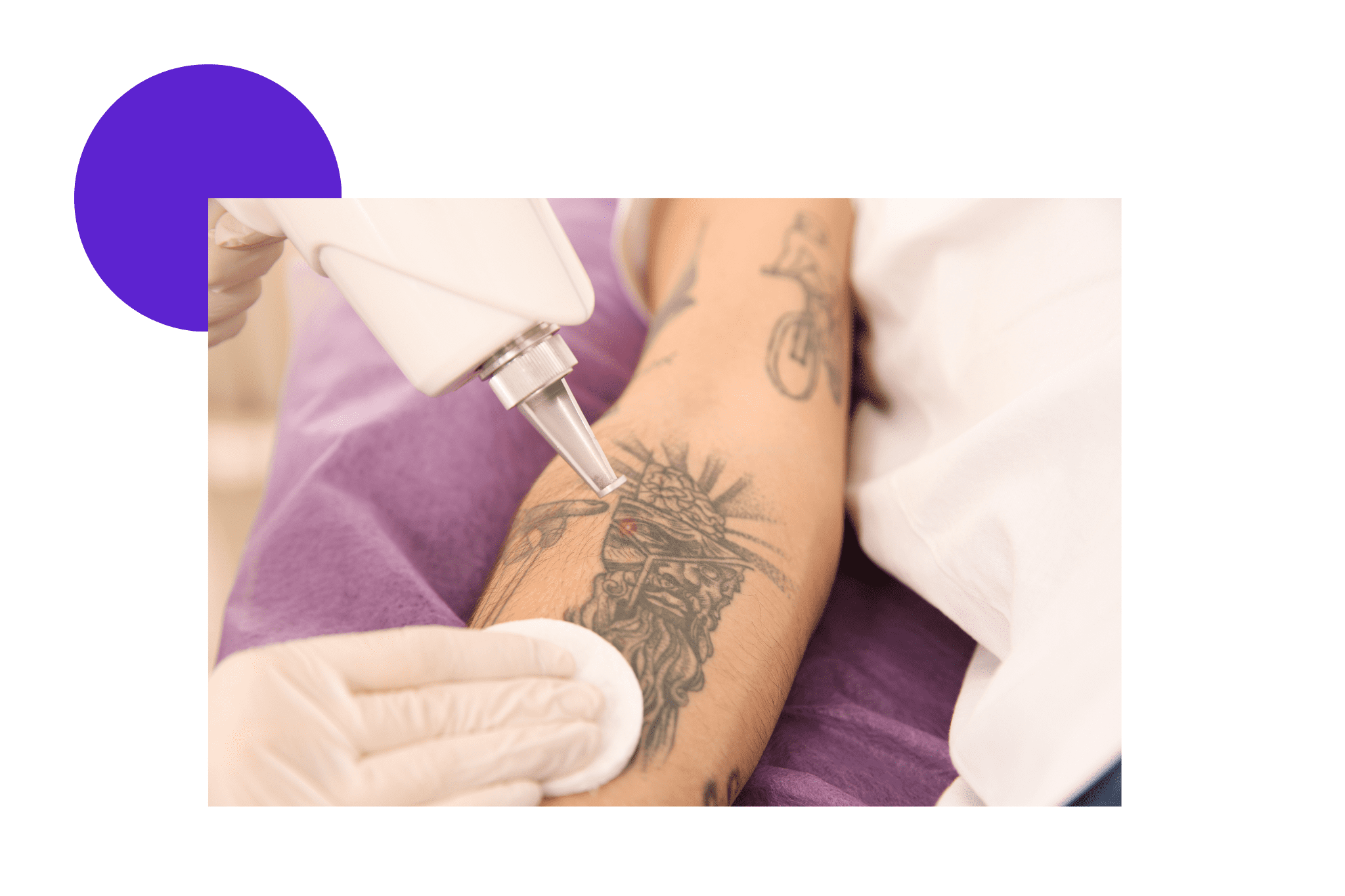 détatouage au laser Pico sur le bras d'une femme