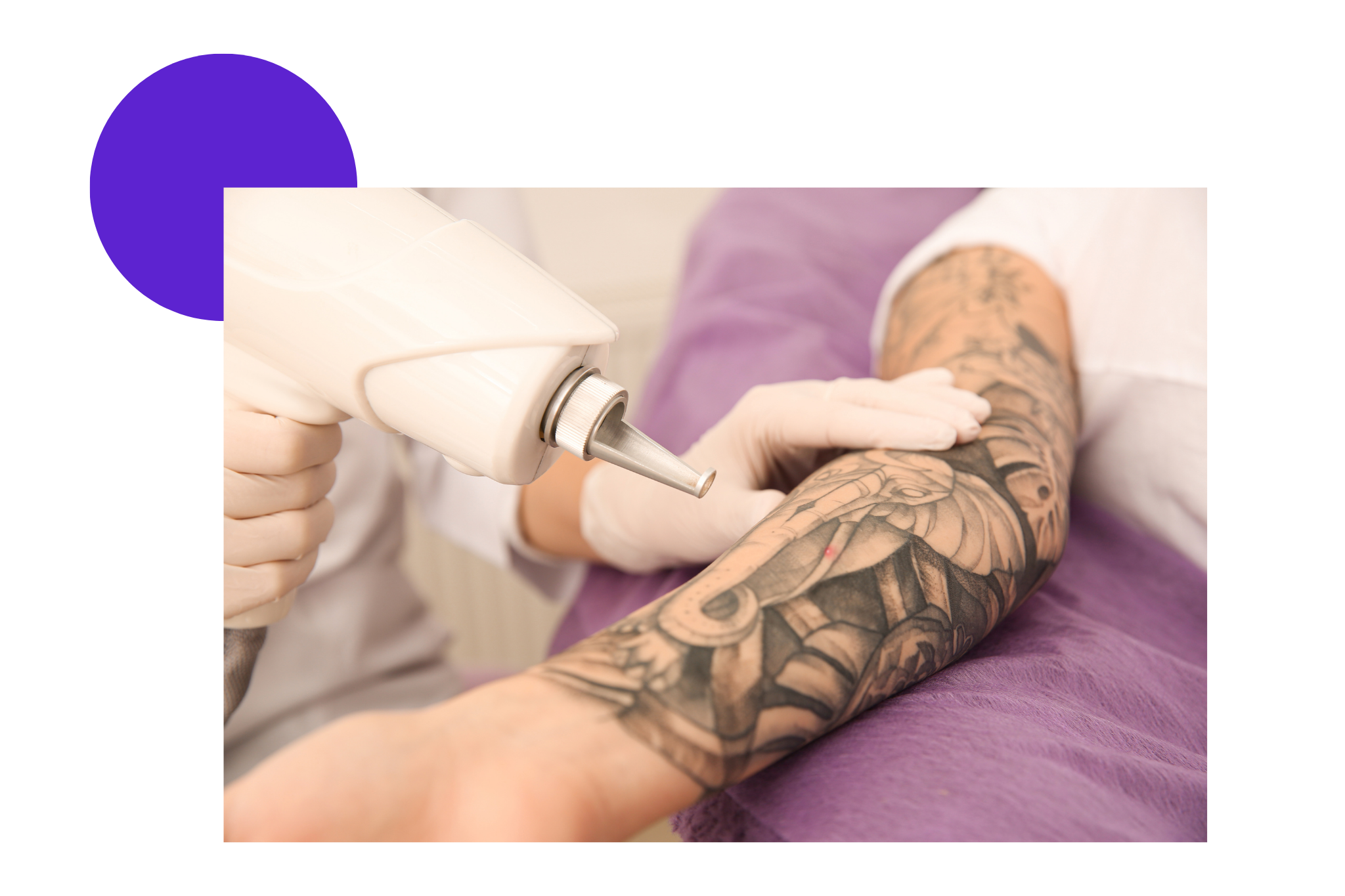 détatouage sur le bras d'une femme