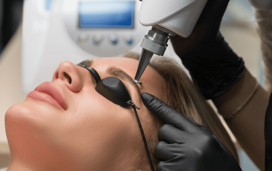 Séance de détatouage au laser d'un microblading des sourcils