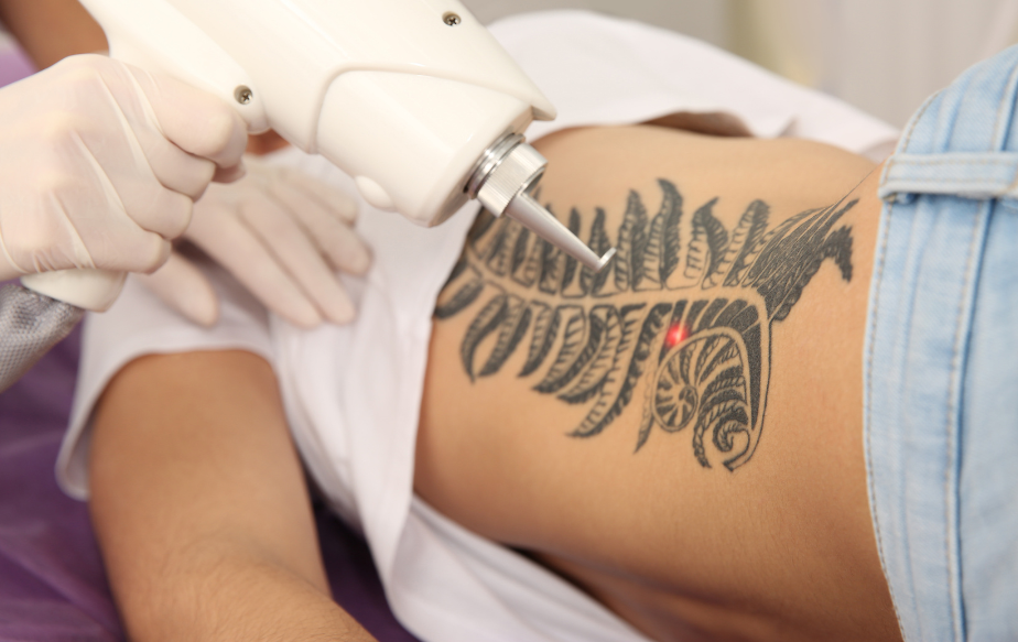 Séance de détatouage d'un tatouage sur le ventre