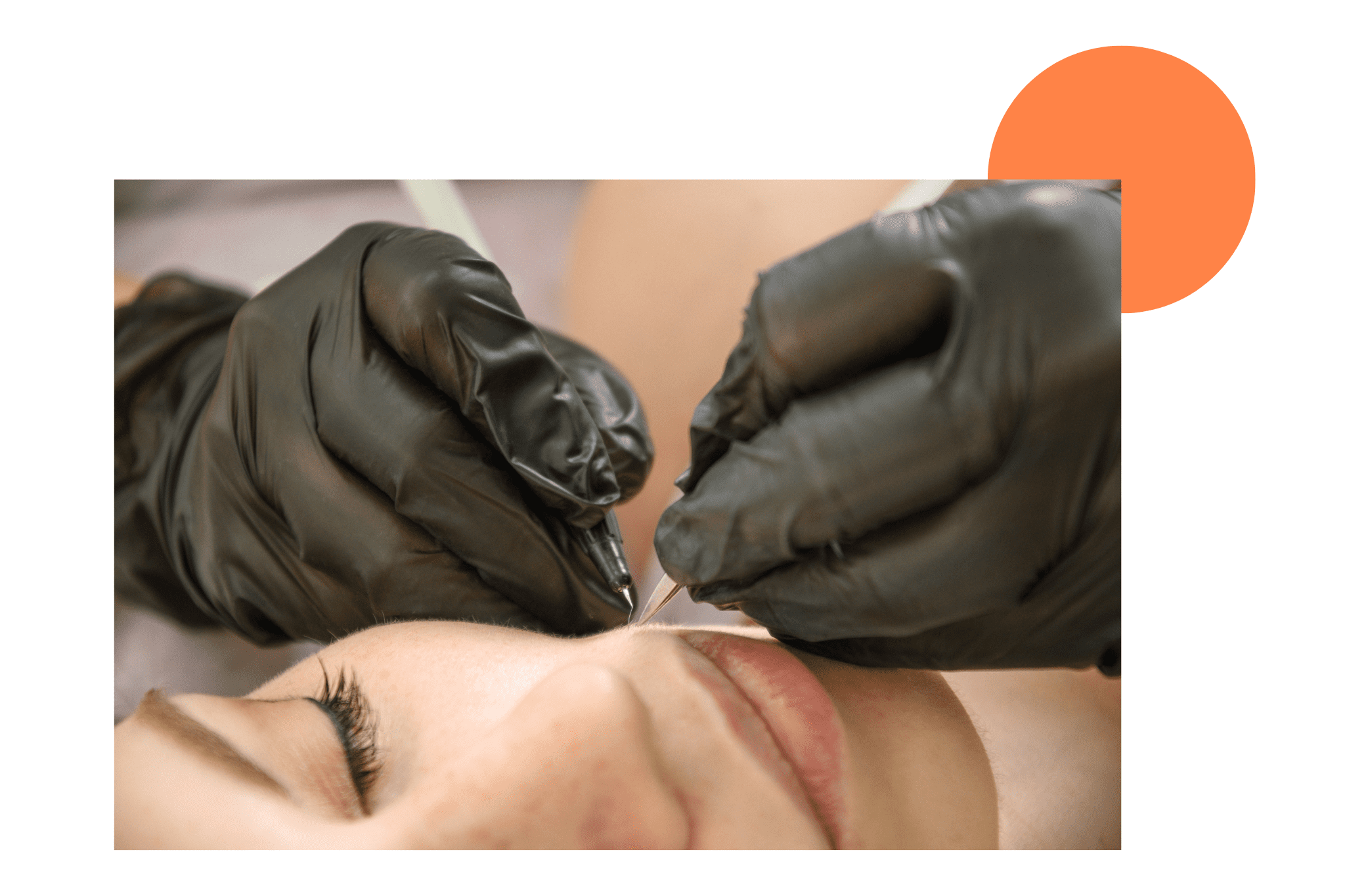 épilation électrolyse du menton d'une femme