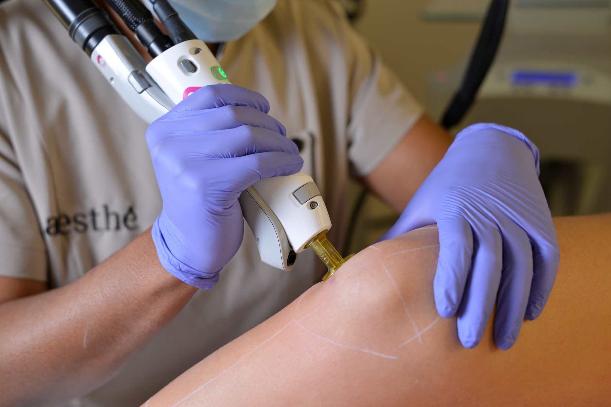 épilation laser du genou avant l'été