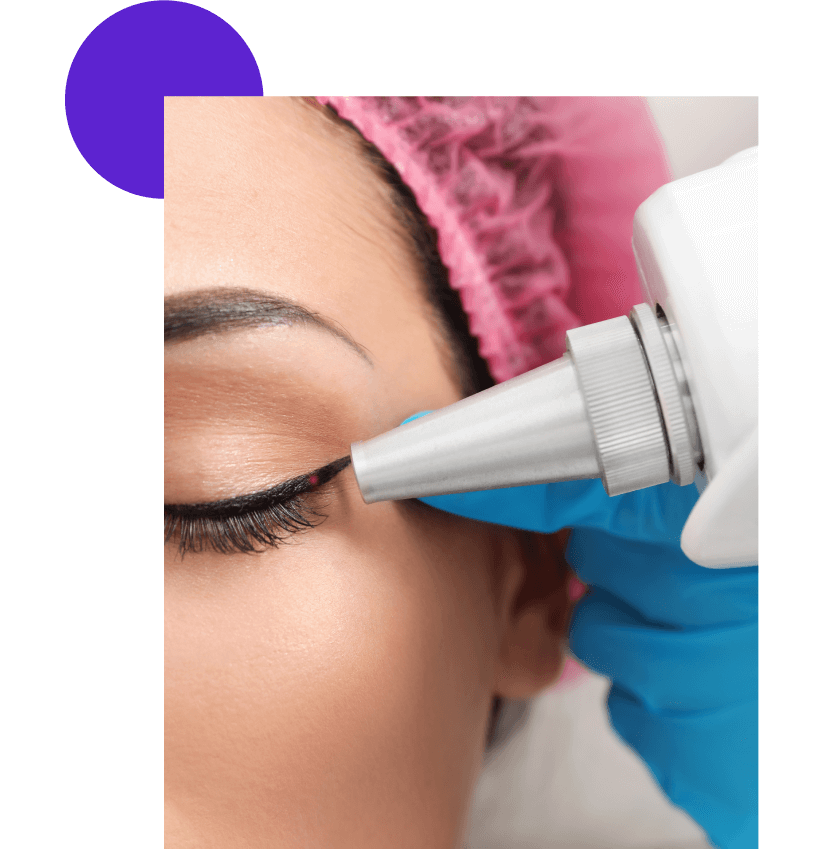 laser sur trait eye liner