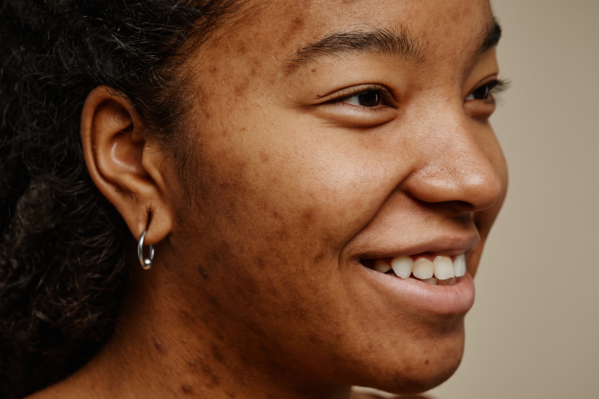 boutons d'acné à cause du soleil