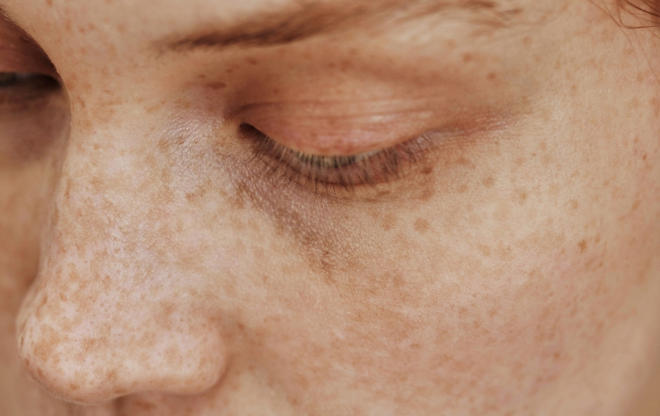 femme avec des taches de rousseur