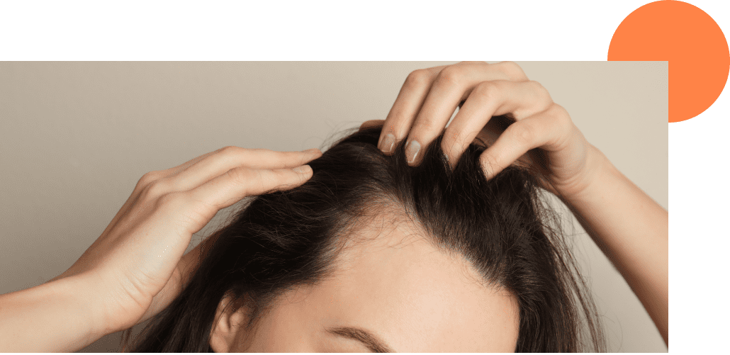 Une femme qui est atteinte de chute de cheveux qui veut faire une greffe de cheveux