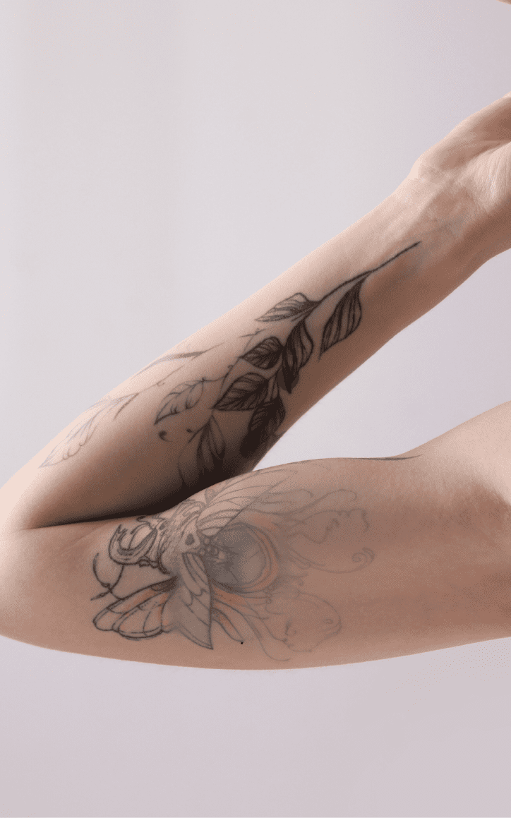 Une femme qui fait des séances de détatouage au laser pour enlever son tatouage sur le bras