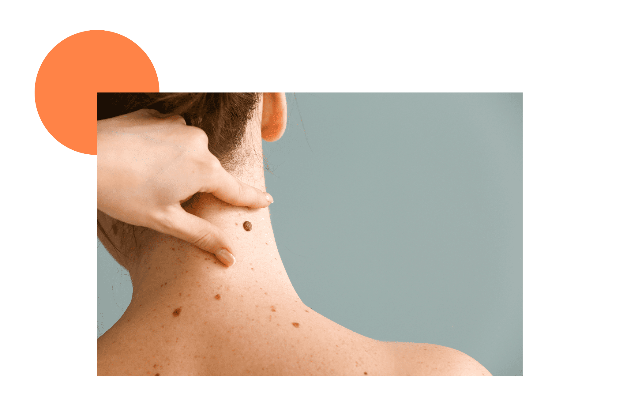 grains de beauté sur la nuque et le dos d'une femme