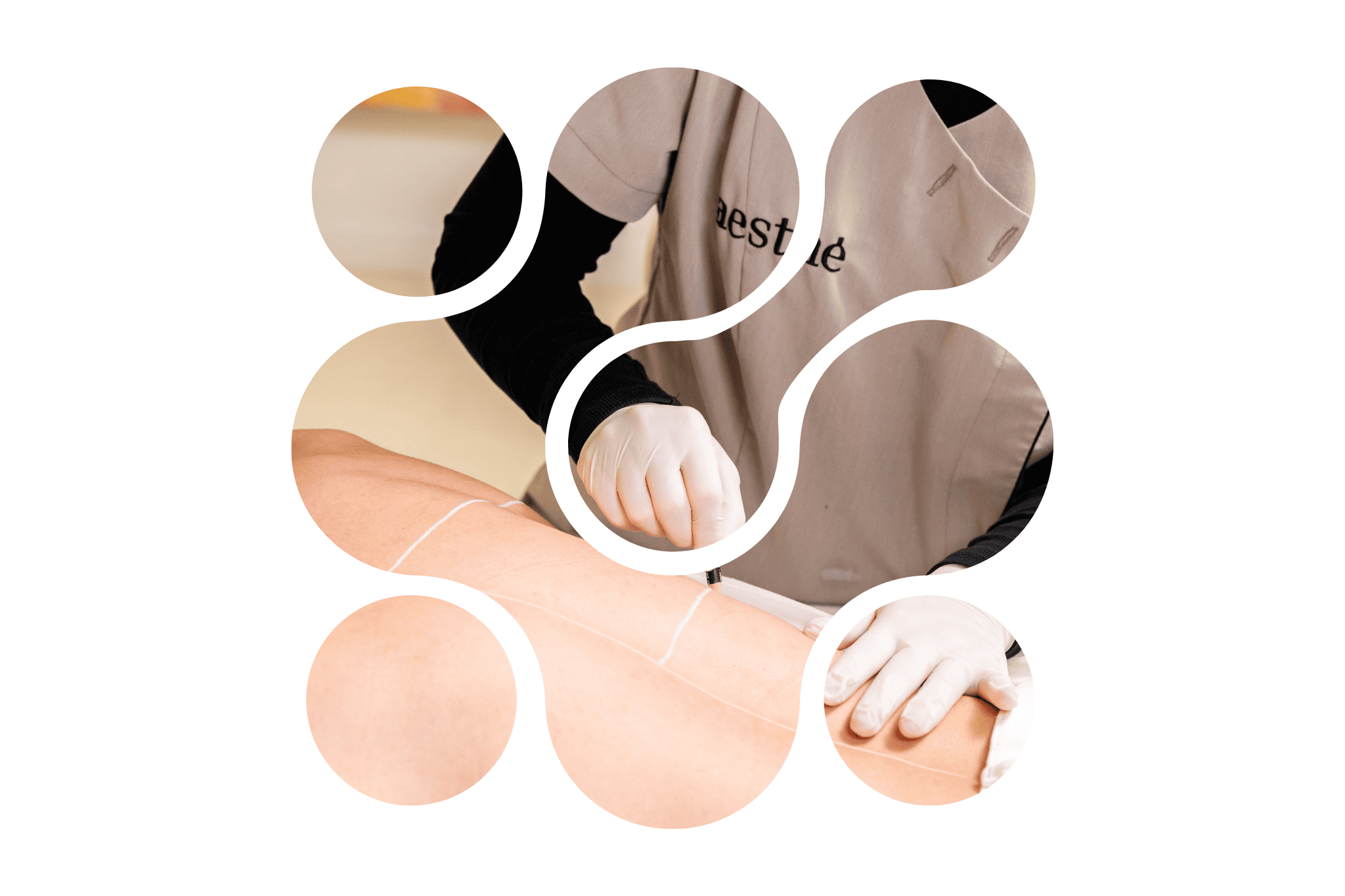 Une praticienne du centre de médecine esthétique aesthé qui identifie un poil incarné sur le dos d'une personne