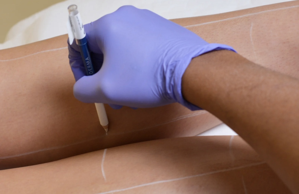 définition de la zone à épiler