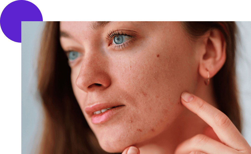 peau à imperfections