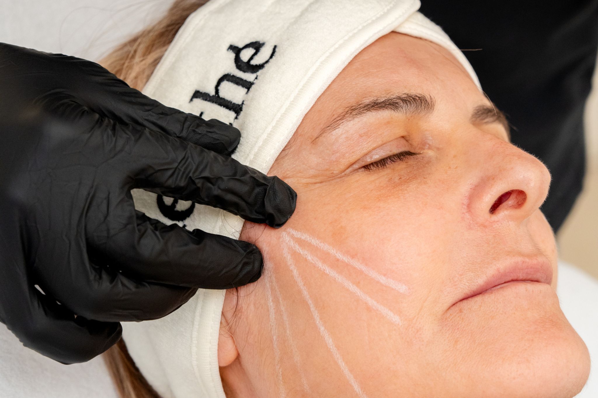 Séance de mésothérapie visage sur une femme âgée