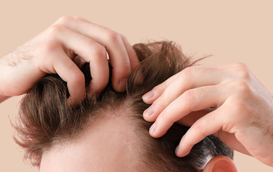 homme qui va faire une greffe en france suite à une perte de cheveux homme