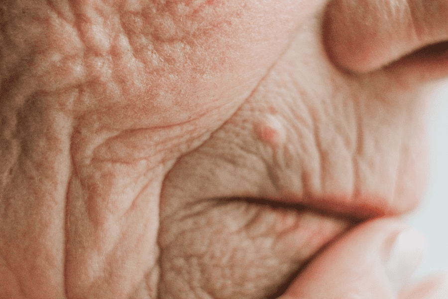 relachement cutané autour de la bouche d'une femme qui cause des fripés de peau