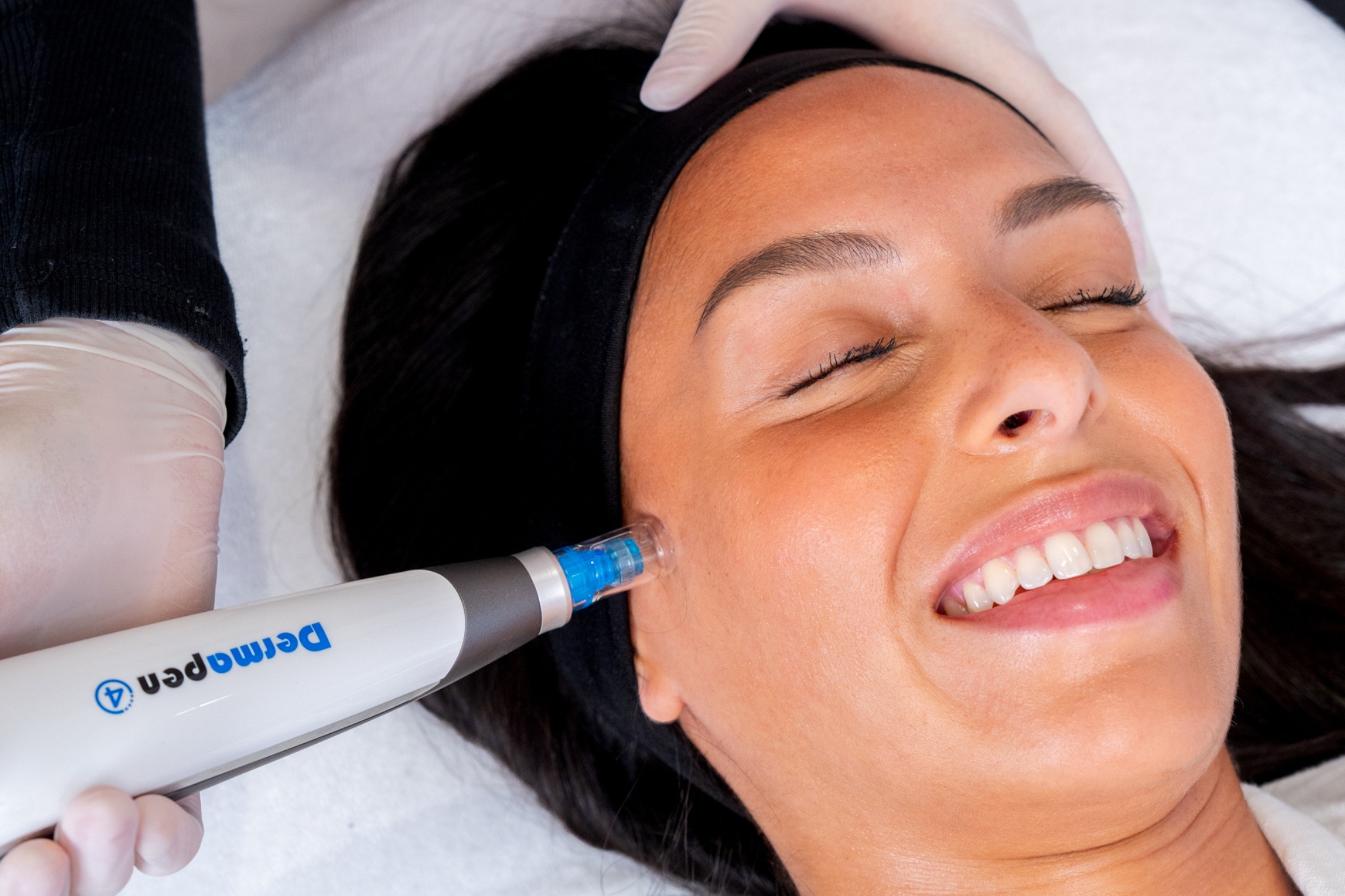 La peau d'une femme réhydratée grâce à un soin microneedling