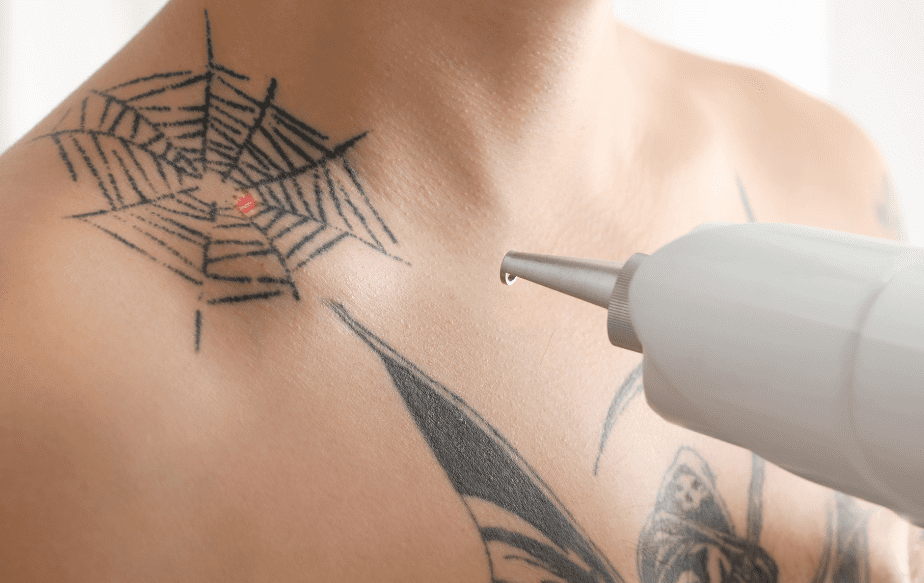séance de détatouage d'une toile d'araignée sur l'épaule d'un homme