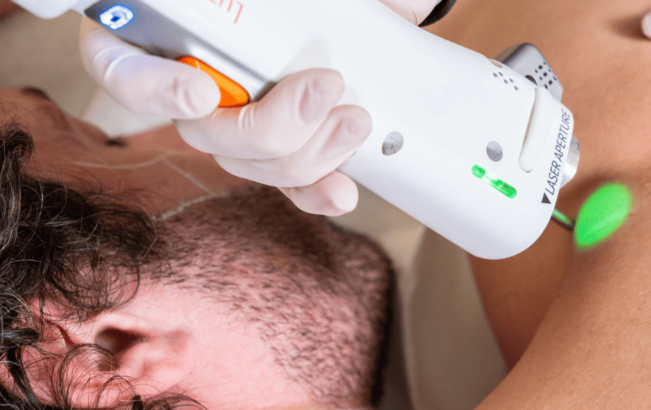 Séance d'épilation laser sur un homme pour éliminer un poil incarné