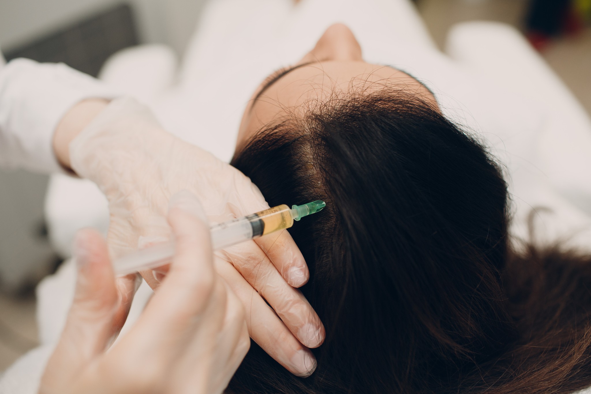Séance de prp cheveux sur une femme qui perd ses cheveux