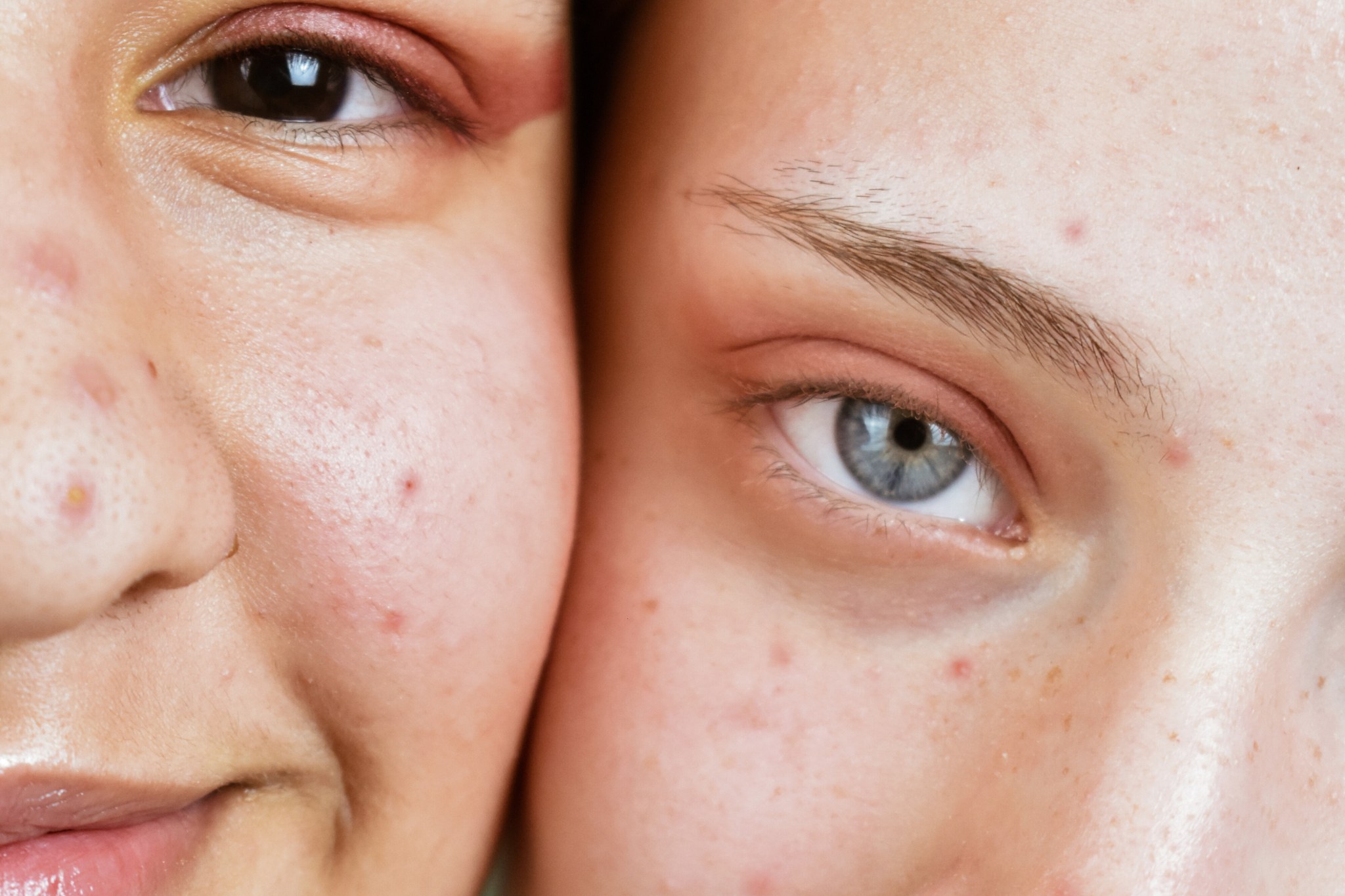 2 personnes qui ont de l'acné sur les joues à cause du stress chronique
