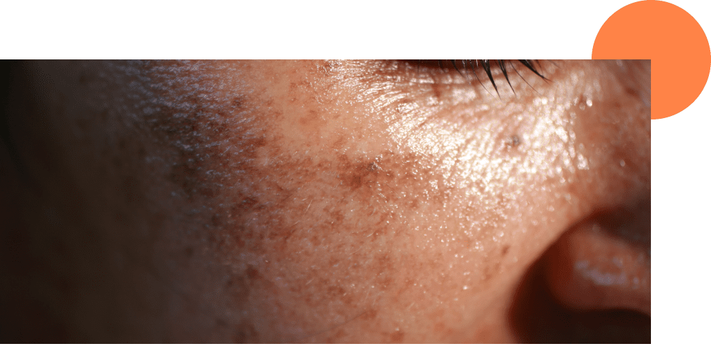 Une personne qui veut atténuer ses taches brunes avec un traitement laser pigmentaire